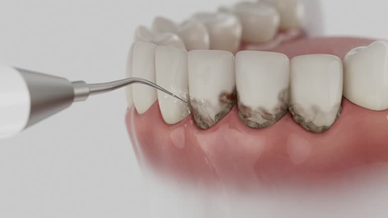 Trusted Wisdom Tooth Removal service in La Croft, OH - Dentist Open Now